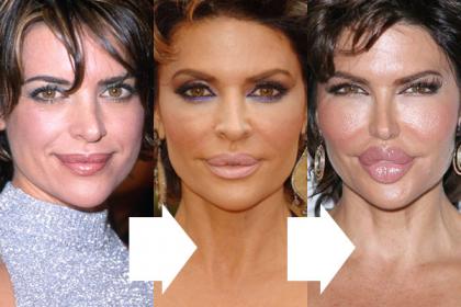 Lisa Rinna Explains What Went Wrong with Her Lips