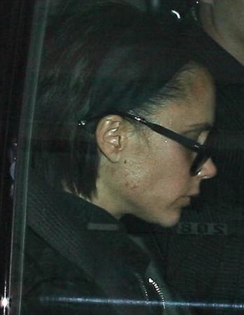 Victoria Beckham Photographed With Severe Acne Breakout