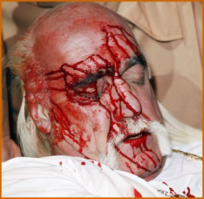 Hulk Hogan With Bloody Head Wound