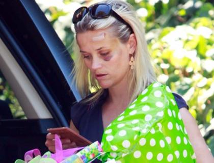 Reese Witherspoon Debuts Post-Accident Black Eye